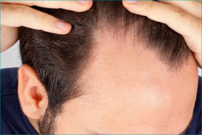 eccessiva perdita capelli