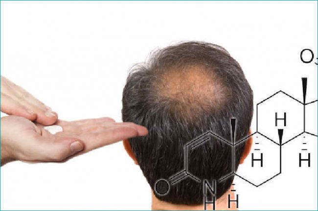 finasteride topica