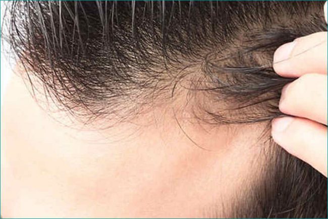 Stempiatura Uomo Rimedi